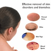 Skin Tags and Thread Vein Removal
